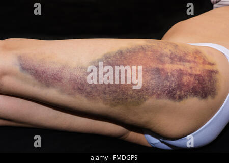 Hematoma on the female butt leg. Woman buttocks bruise. Domestic violence  concept. Young woman with a hematoma on buttocks. Skin bruises on Caucasian  Stock Photo - Alamy