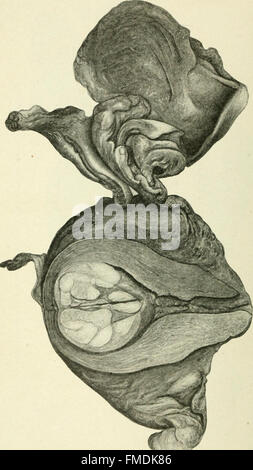 Fibroids and allied tumours (myoma and adenomyoma) - their pathology, clinical features and surgical treatment (1918)