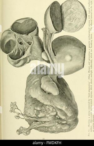 Fibroids and allied tumours (myoma and adenomyoma) - their pathology, clinical features and surgical treatment (1918)