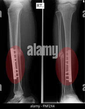 Fracture Elbow, forearm x-rays image showing plate and screw fixation Stock Photo