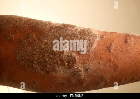 Arm with an unknown skin lesion. Stock Photo