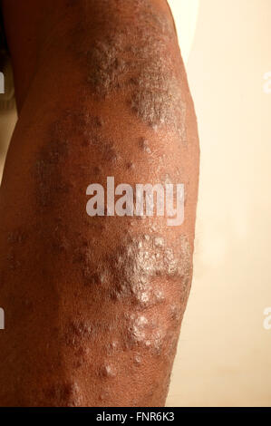 Arm with an unknown skin lesion. Stock Photo