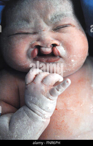 Close up of a new born baby, born with a complete bilateral  cleft palate, a congenital deformity. Stock Photo