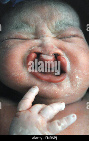 Close up of a new born baby, born with a complete bilateral  cleft palate, a congenital deformity. Stock Photo