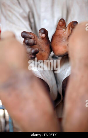 Leprosy patient known also as Leper,a disease called by Mycobacterium Leprae. Stock Photo