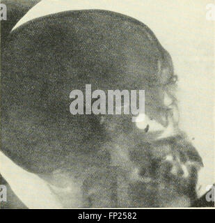 This 1915 text discusses the use of radiography, X-ray therapy, and ...
