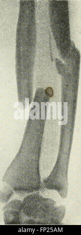 This 1915 book discusses radiography, X-ray therapeutics, and radium ...