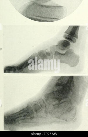 Radiography, x-ray therapeutics and radium therapy (1915) Stock Photo