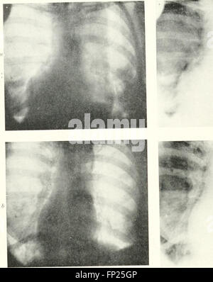 This 1915 work covers the medical uses of radiography, X-ray ...
