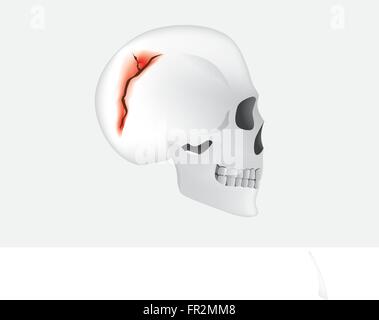 Skull fracture in side view Stock Vector