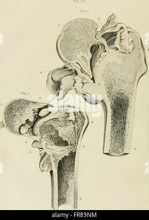 A treatise on dislocations and on fractures of the joints (1824) Stock Photo