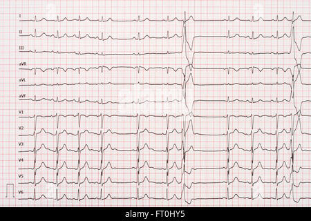 Extrasystole On 12 Lead Electrocardiogram Record Paper Stock Photo