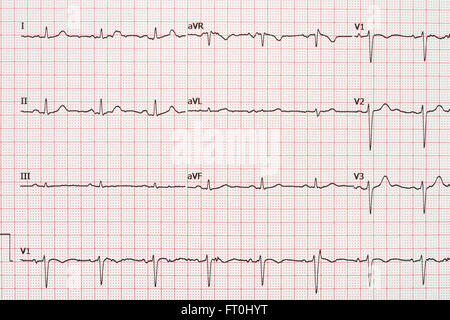 Extrasystole On 12 Lead Electrocardiogram Record Paper Stock Photo