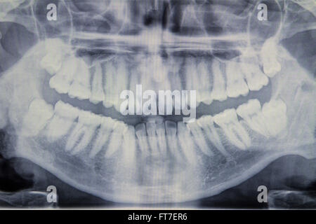 Panoramic radiograph is a scanning dental X-ray of the upper jaw ...