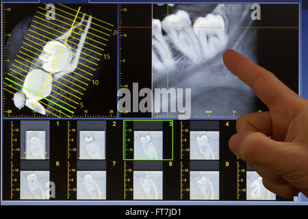 Doctor indicating a wisdom tooth on X-ray computed tomography Stock Photo