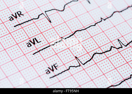 Electrogram Sinus Electrocardiogram showing normal sinus rhythm Stock Photo - Alamy