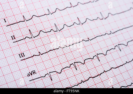 Sinus Heart Rhythm On Electrocardiogram Record Paper Showing Normal P Wave, PR and QT Interval and QRS Complex Stock Photo