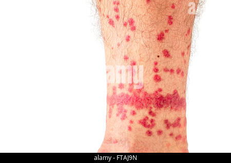 Extreme case of flea bites on humans Stock Photo - Alamy