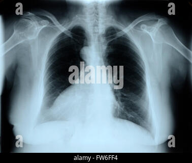 X-Ray Image Of Human Chest Stock Photo