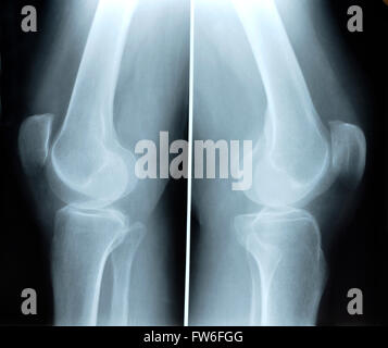 X-ray picture showing knee joints Stock Photo