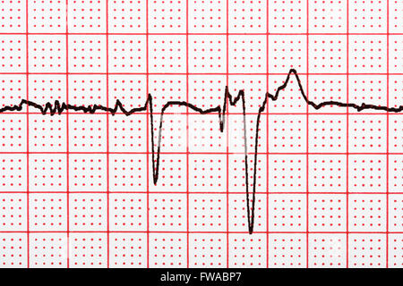 Extrasystole On 12 Lead Electrocardiogram Record Paper Stock Photo
