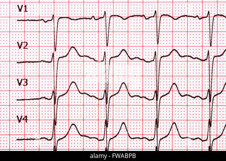 Extrasystole On 12 Lead Electrocardiogram Record Paper Stock Photo