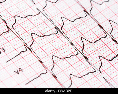 Extrasystole On 12 Lead Electrocardiogram Record Paper Stock Photo