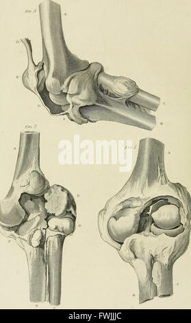 A treatise on dislocations and on fractures of the joints (1824) Stock Photo