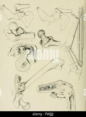 A treatise on dislocations and on fractures of the joints (1824) Stock Photo