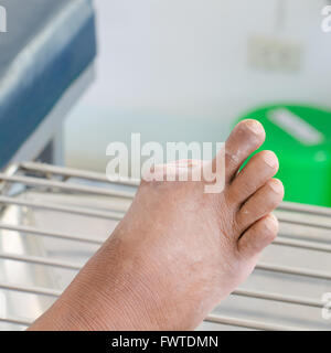 Blister on the toe of diabetic patient. Stock Photo