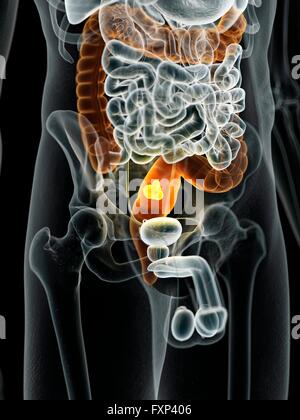 Human bowel cancer, computer illustration. Stock Photo