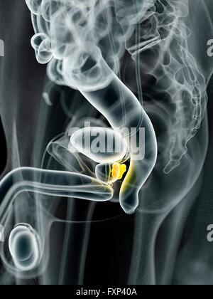 Human prostate cancer, computer illustration. Stock Photo