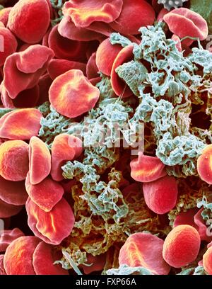 Red blood cells and platelets. Coloured scanning electon micrograph (SEM) of human erythrocytes (red blood cells) and a platelet aggregate (blue). Platelets are fragments of white blood cells that under normal circumstances are small and biconcave in form. However, if there is a break in the surface of a blood vessel the platelets come into contact with molecules they are not used to and become activated. They become amorphous in form, with long projections (pseudopodia) that help them adhere to other cells and each other, forming a clot. Magnification: x3000 when printed at 10 centimetres Stock Photo