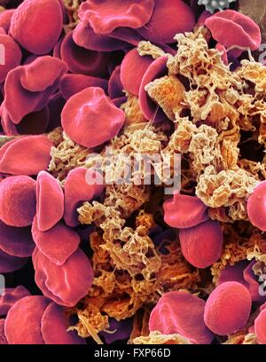 Red blood cells and platelets. Coloured scanning electon micrograph (SEM) of human erythrocytes (red blood cells) and a platelet aggregate (orange). Platelets are fragments of white blood cells that under normal circumstances are small and biconcave in form. However, if there is a break in the surface of a blood vessel the platelets come into contact with molecules they are not used to and become activated. They become amorphous in form, with long projections (pseudopodia) that help them adhere to other cells and each other, forming a clot. Magnification: x3000 when printed at 10 centimetres Stock Photo