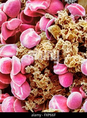 Red blood cells and platelets. Coloured scanning electon micrograph (SEM) of human erythrocytes (red blood cells) and a platelet aggregate (orange). Platelets are fragments of white blood cells that under normal circumstances are small and biconcave in form. However, if there is a break in the surface of a blood vessel the platelets come into contact with molecules they are not used to and become activated. They become amorphous in form, with long projections (pseudopodia) that help them adhere to other cells and each other, forming a clot. Magnification: x3000 when printed at 10 centimetres Stock Photo