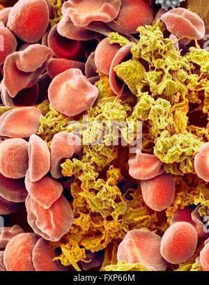 Red blood cells and platelets. Coloured scanning electon micrograph (SEM) of human erythrocytes (red blood cells) and a platelet aggregate (yellow). Platelets are fragments of white blood cells that under normal circumstances are small and biconcave in form. However, if there is a break in the surface of a blood vessel the platelets come into contact with molecules they are not used to and become activated. They become amorphous in form, with long projections (pseudopodia) that help them adhere to other cells and each other, forming a clot. Magnification: x3000 when printed at 10 centimetres Stock Photo