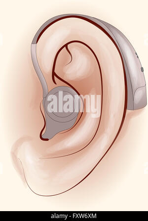 hearing aid. Stock Photo