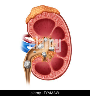 Kidney stones medical concept as a human organ with painful crystaline mineral formations as a medical symbol with a cross section as a 3D illustration style. Stock Photo