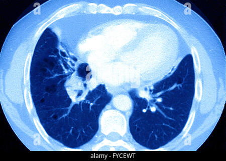 LUNG CANCER, CT SCAN Stock Photo: 184638840 - Alamy