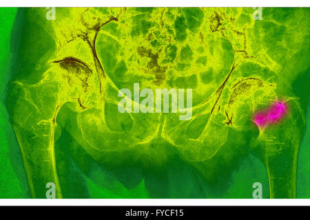 FRACTURED HIP, X-RAY Stock Photo