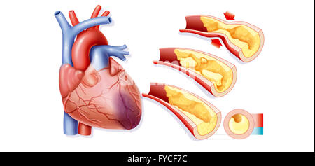 HEART ATTACK, DRAWING Stock Photo - Alamy