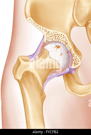 OSTEOARTHRITIS, ILLUSTRATION Stock Photo