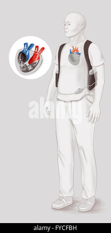 ARTIFICIAL HEART, DRAWING Stock Photo