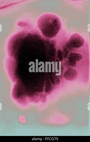 KIDNEY CYST, X-RAY Stock Photo