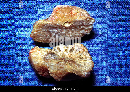 URINARY STONE Stock Photo