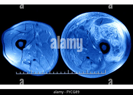 THIGH HEMATOMA, MRI Stock Photo