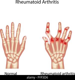 RHEUMATOID NODULE Stock Photo - Alamy