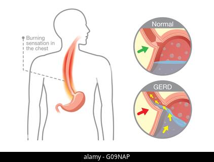 Cause Of Gastroesophageal Reflux Disease In Human Stomach Stock Vector ...