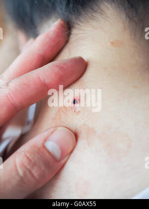 Fresh wound in neck Stock Photo