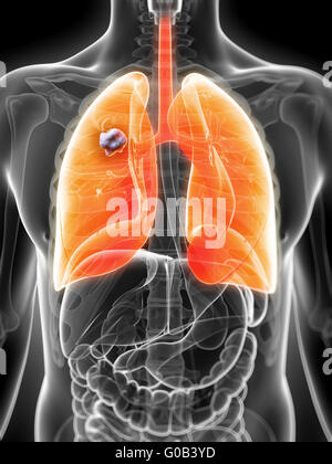 3d rendered illustration of the male lung - cancer Stock Photo